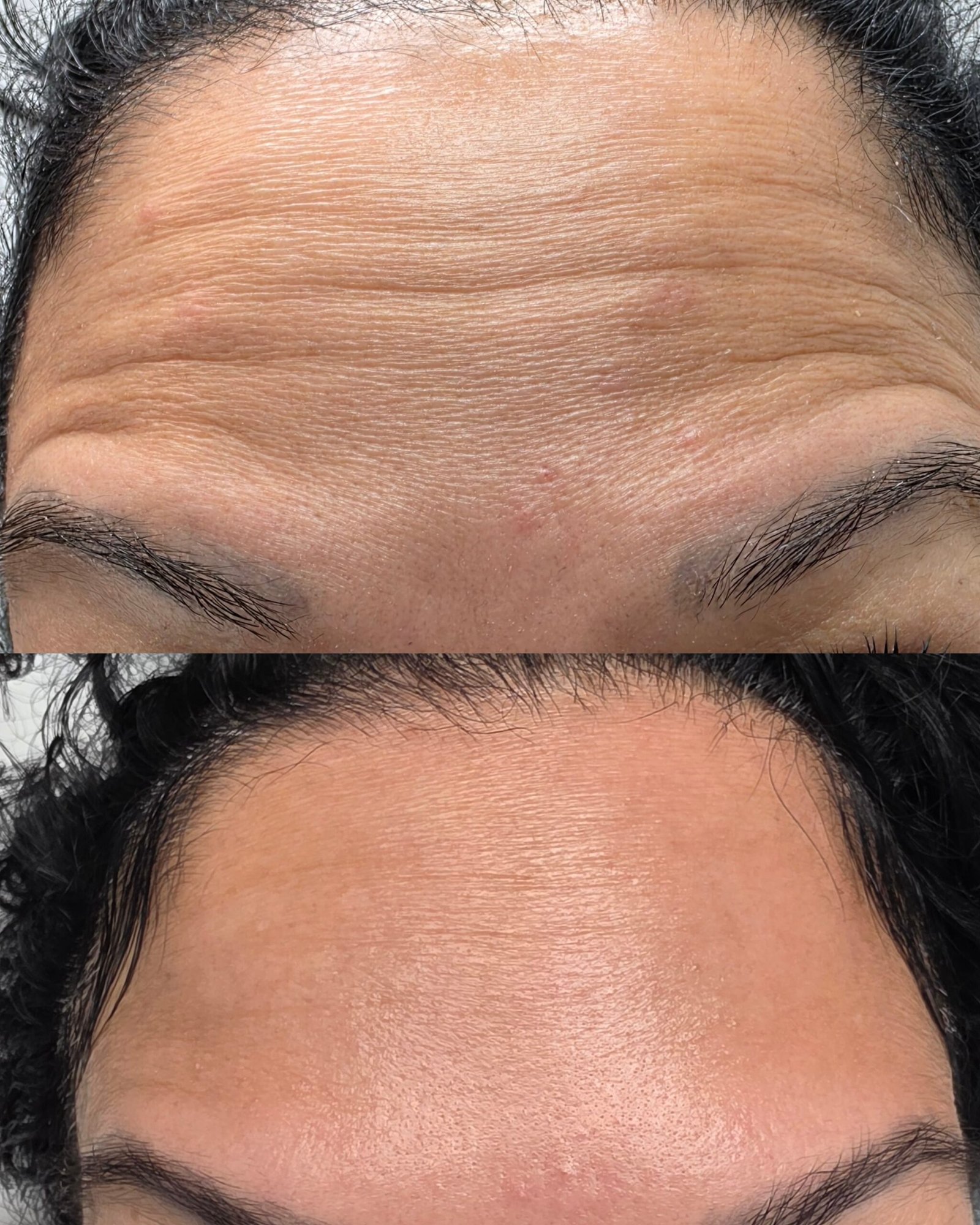 Aplicación técnica de microneedling con Dermapen en zona facial